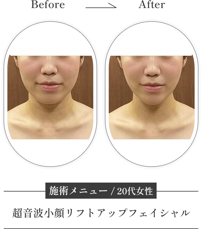 施術メニュー 超音波小顔リフトアップフェイシャル